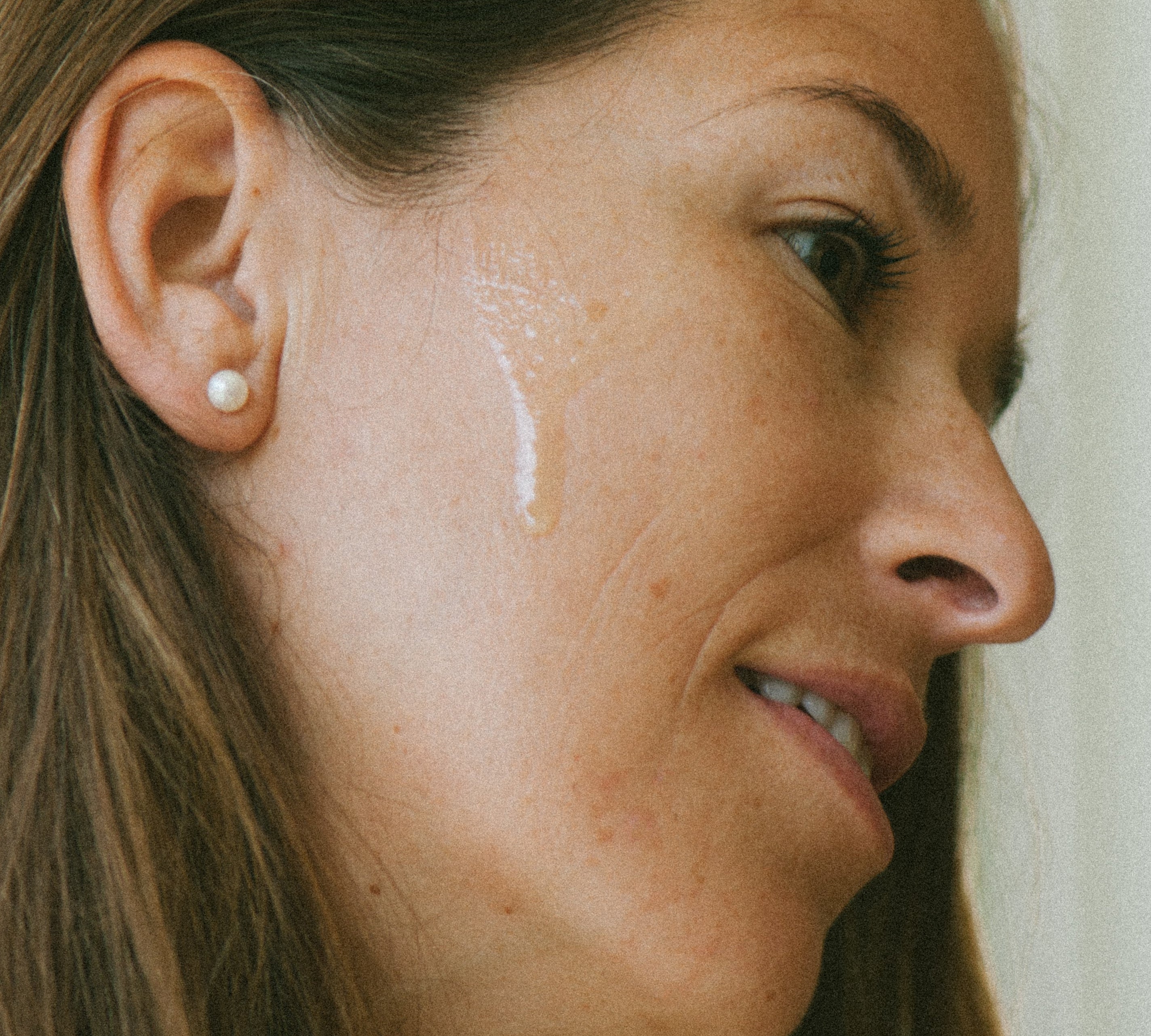 Why Summer Triggers Breakouts & How to Stop Them
