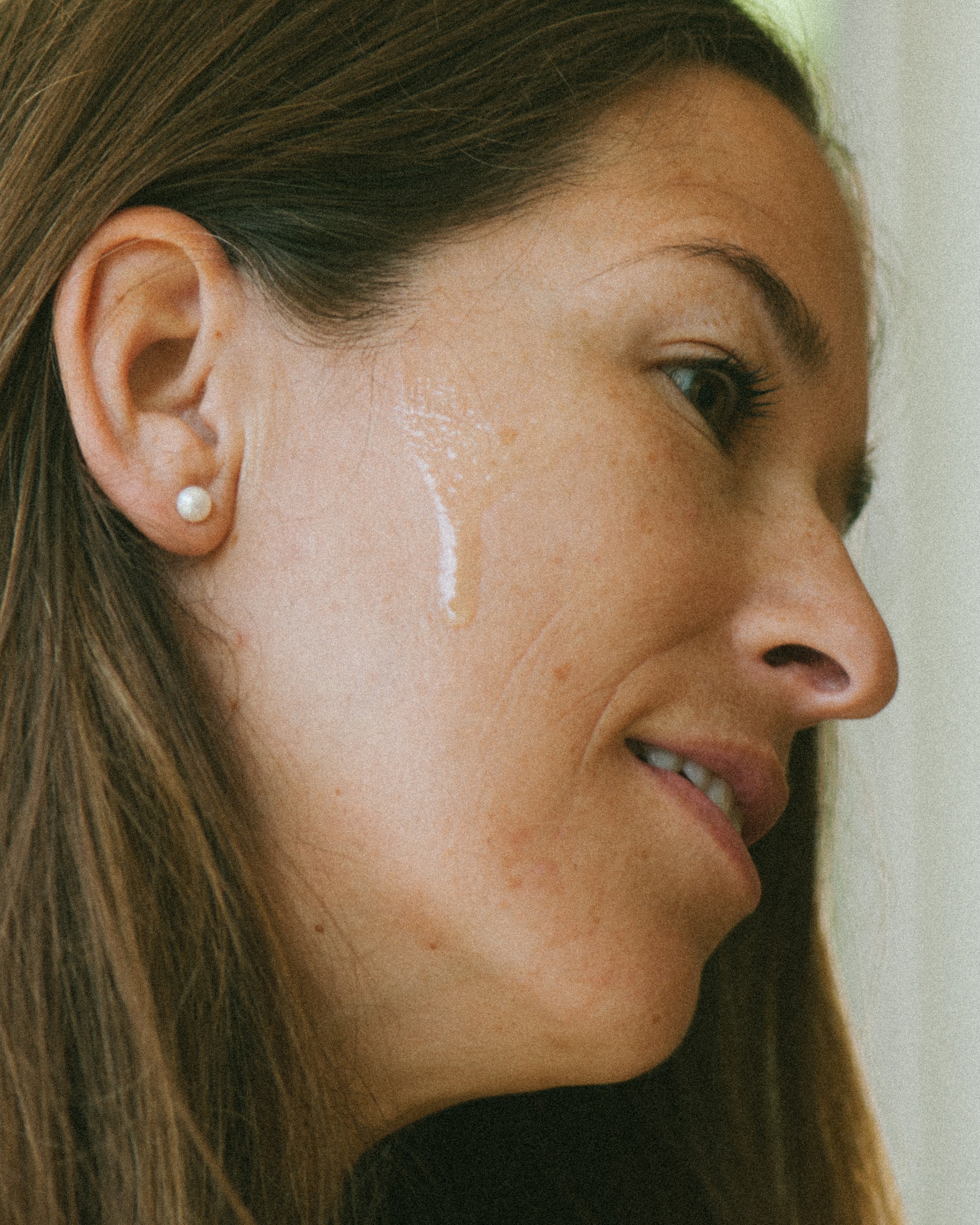 Why Summer Triggers Breakouts & How to Stop Them